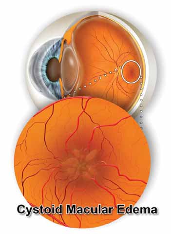 Cystoid Macular Edema